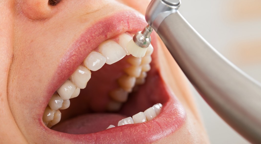 Семь причин сделать чистку зубов у стоматолога